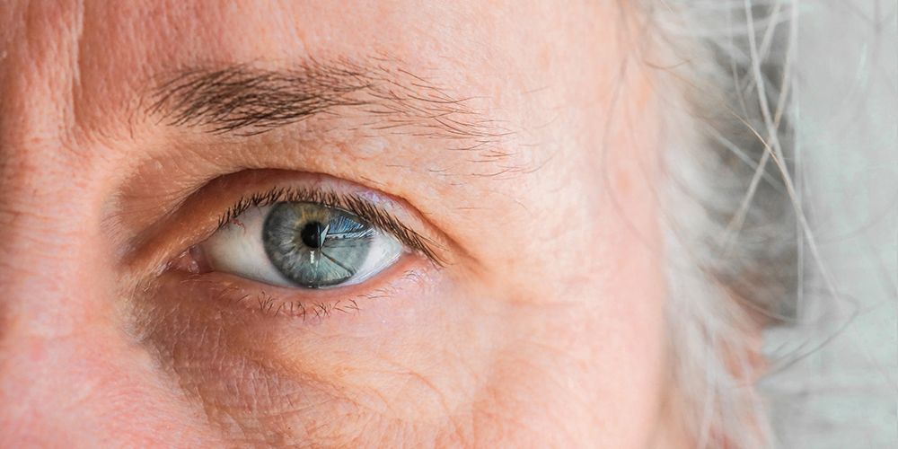 Nahaufnahme eines Auges mit Anzeichen altersbedingter Makuladegeneration